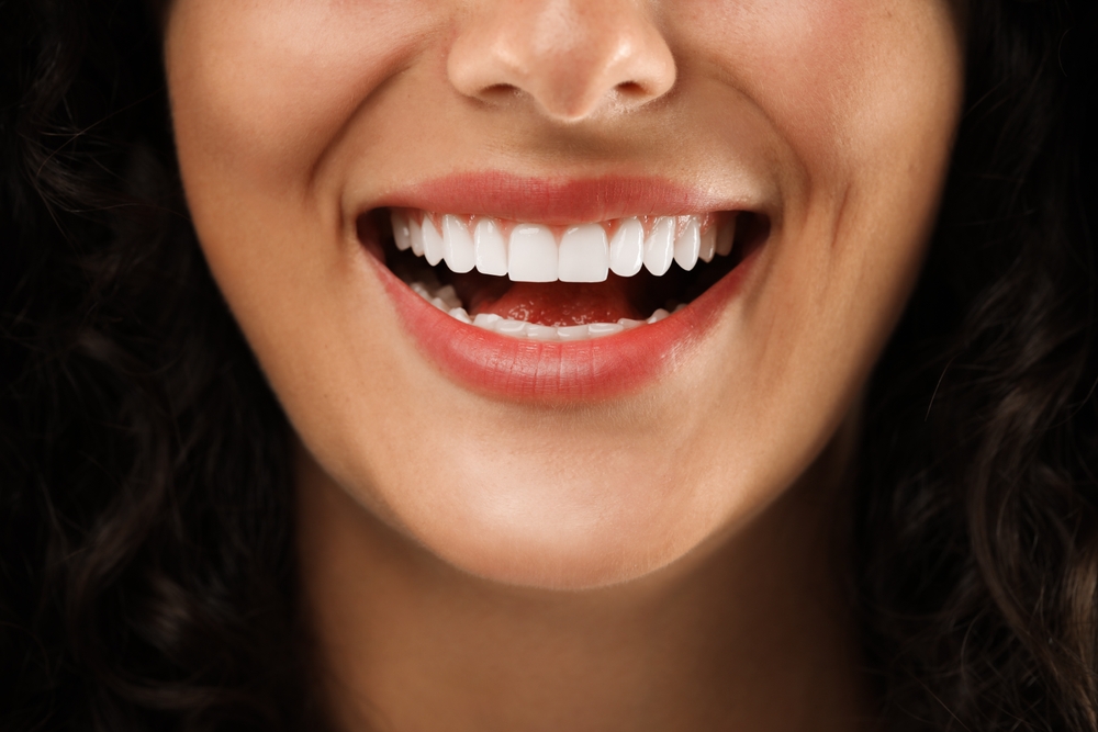 Veneers in Palm Bay